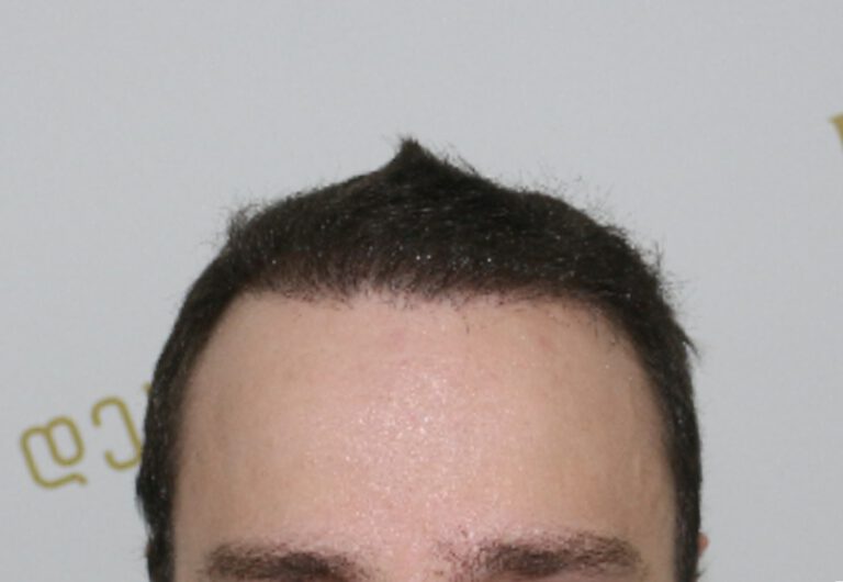 Deamed - hair transplantation results / თმის გადანერგვის შედეგები