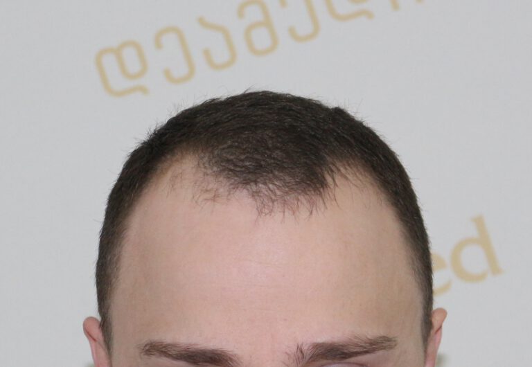 Deamed - hair transplantation results / თმის გადანერგვის შედეგები