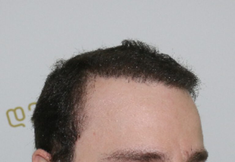 Deamed - hair transplantation results / თმის გადანერგვის შედეგები