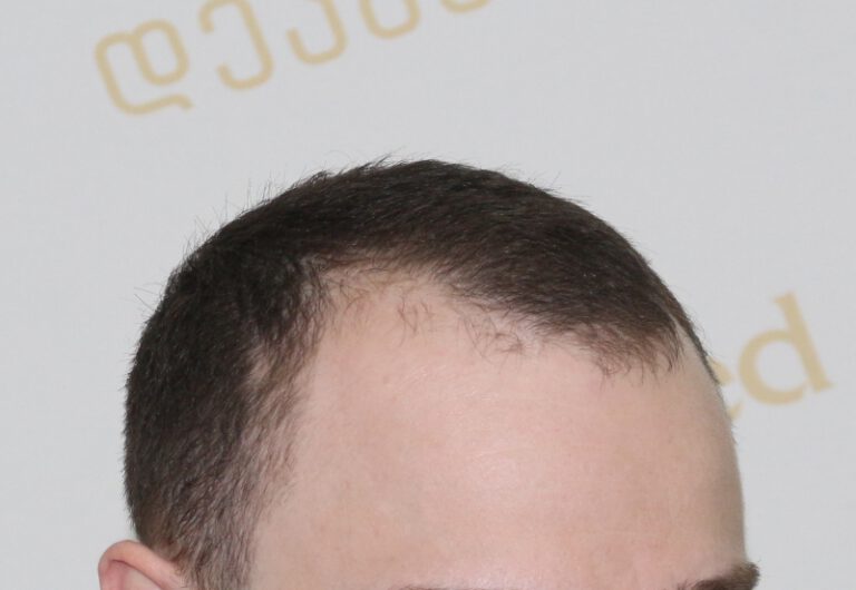 Deamed - hair transplantation results / თმის გადანერგვის შედეგები