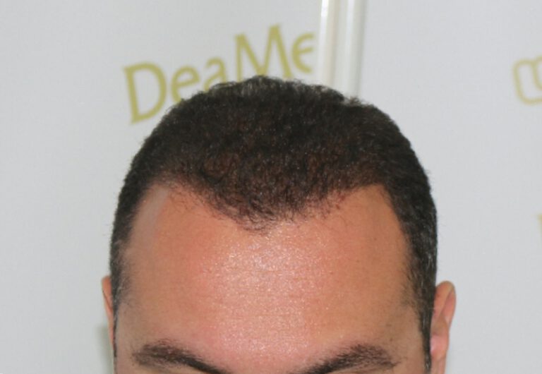 Deamed - hair transplantation results / თმის გადანერგვის შედეგები