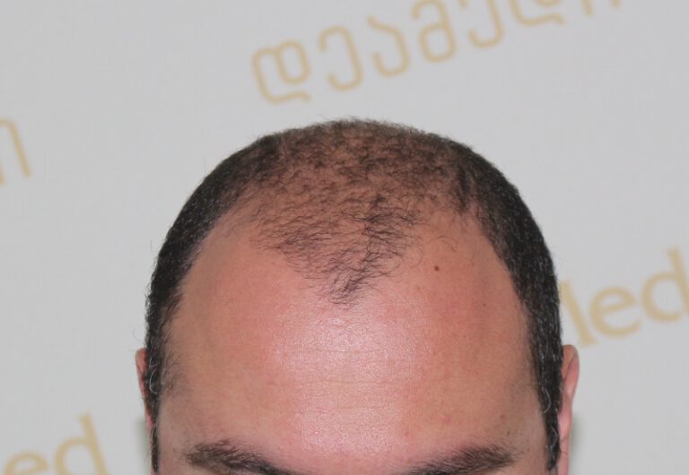 Deamed - hair transplantation results / თმის გადანერგვის შედეგები