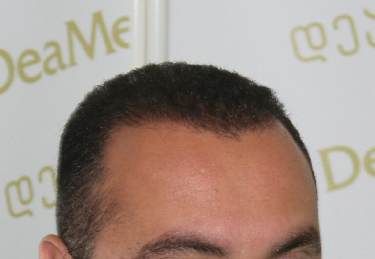 Deamed - hair transplantation results / თმის გადანერგვის შედეგები