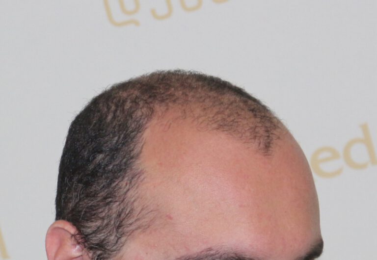 Deamed - hair transplantation results / თმის გადანერგვის შედეგები