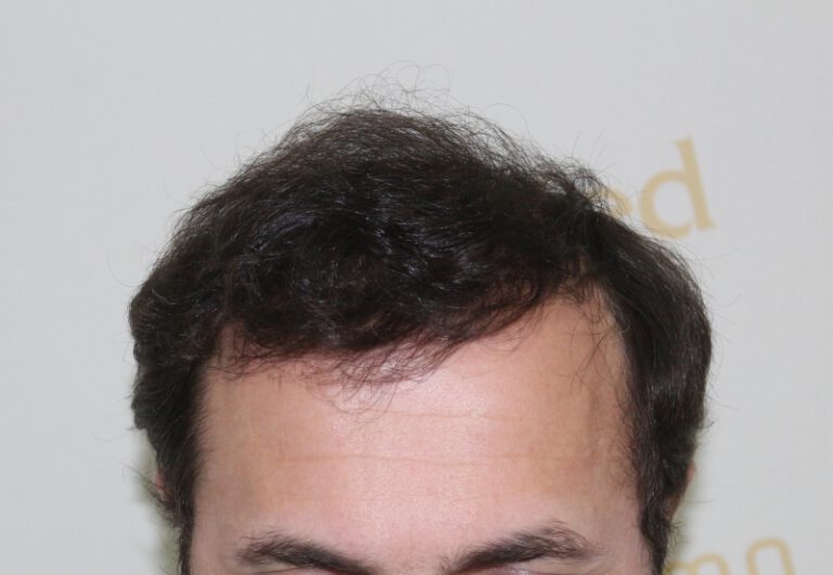 Deamed - hair transplantation results / თმის გადანერგვის შედეგები