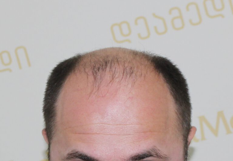 Deamed - hair transplantation results / თმის გადანერგვის შედეგები