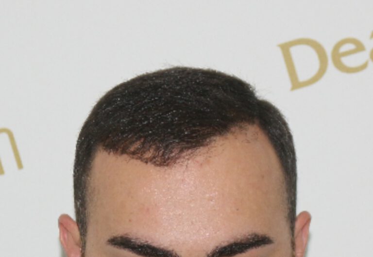 Deamed - hair transplantation results / თმის გადანერგვის შედეგები