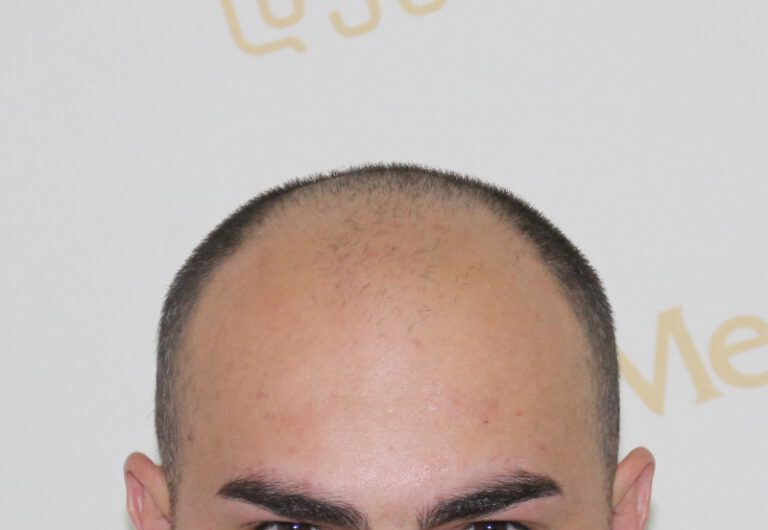 Deamed - hair transplantation results / თმის გადანერგვის შედეგები