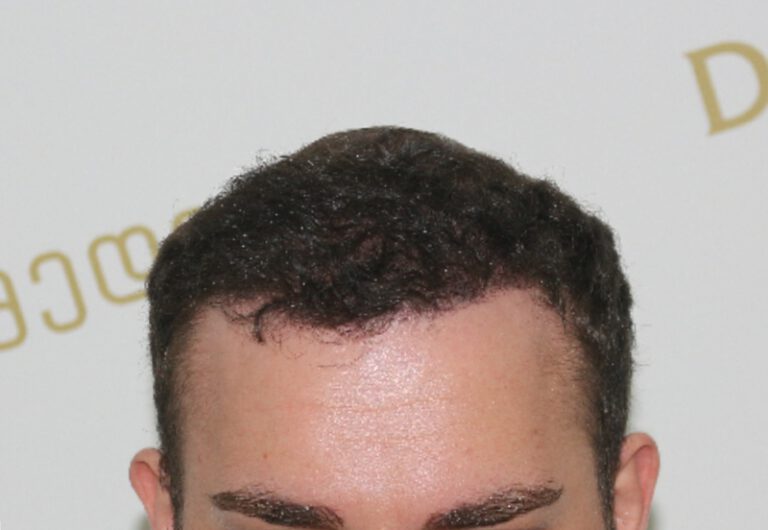 Deamed - hair transplantation results / თმის გადანერგვის შედეგები
