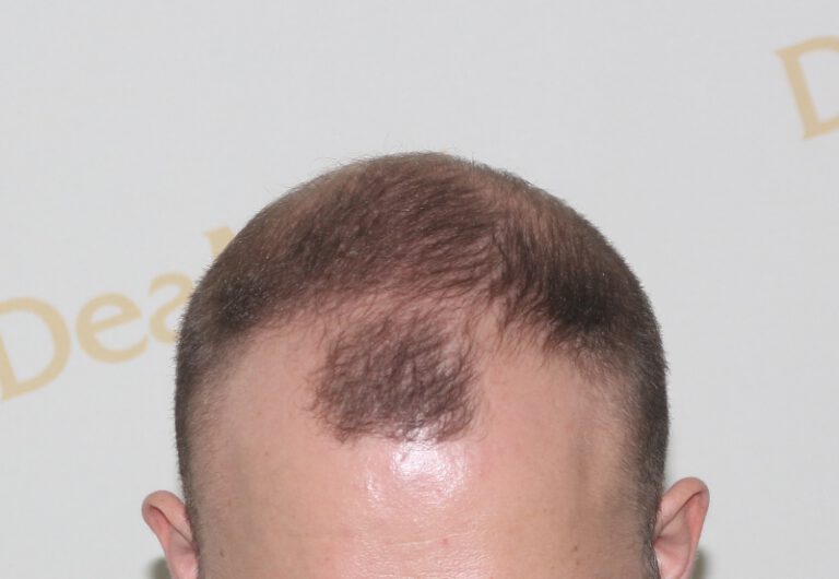 Deamed - hair transplantation results / თმის გადანერგვის შედეგები