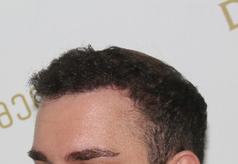 Deamed - hair transplantation results / თმის გადანერგვის შედეგები