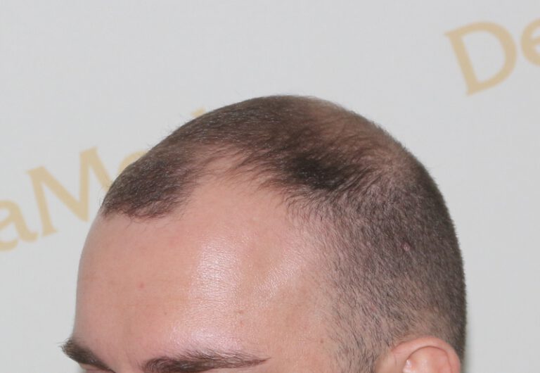 Deamed - hair transplantation results / თმის გადანერგვის შედეგები