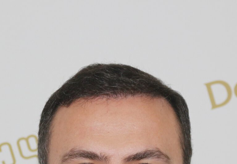 Deamed - hair transplantation results / თმის გადანერგვის შედეგები