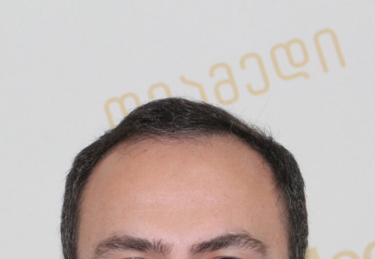 Deamed - hair transplantation results / თმის გადანერგვის შედეგები