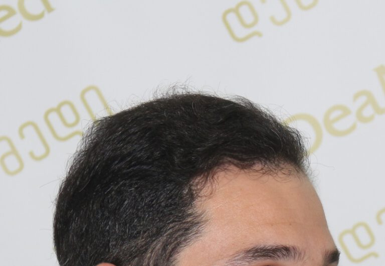 Deamed - hair transplantation results / თმის გადანერგვის შედეგები