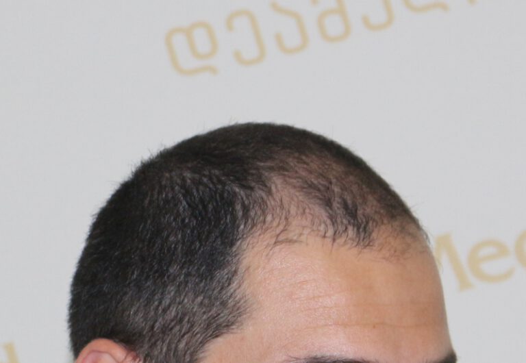 Deamed - hair transplantation results / თმის გადანერგვის შედეგები