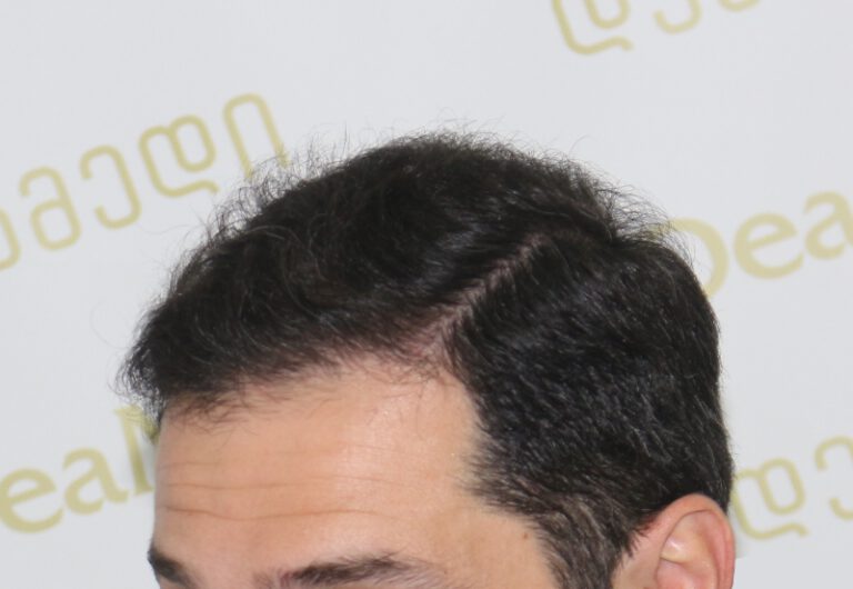 Deamed - hair transplantation results / თმის გადანერგვის შედეგები