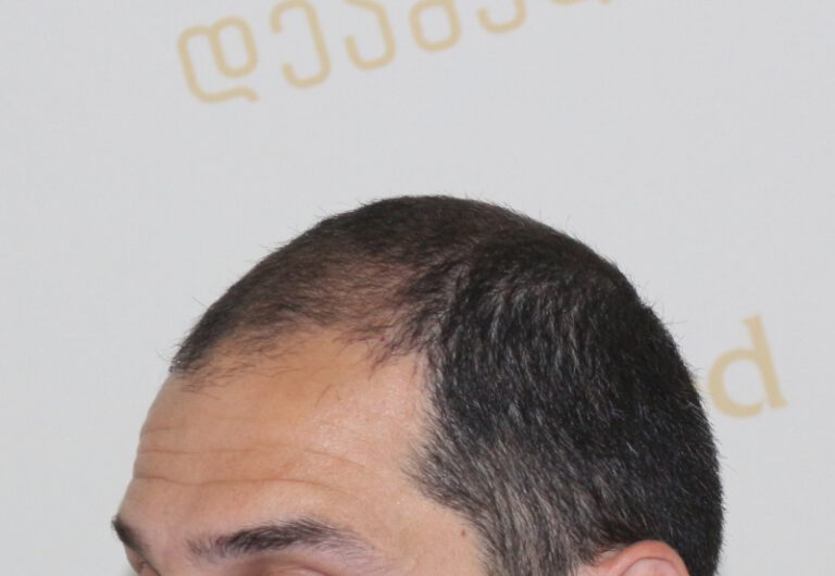 Deamed - hair transplantation results / თმის გადანერგვის შედეგები