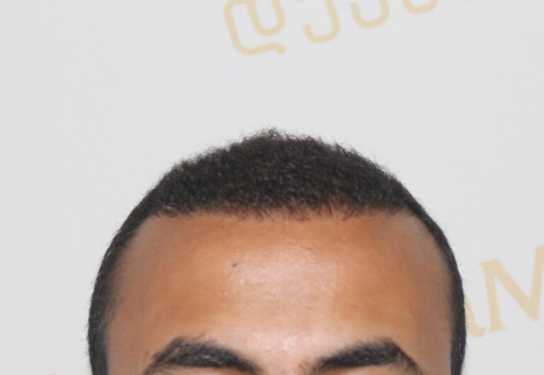 Deamed - hair transplantation results / თმის გადანერგვის შედეგები