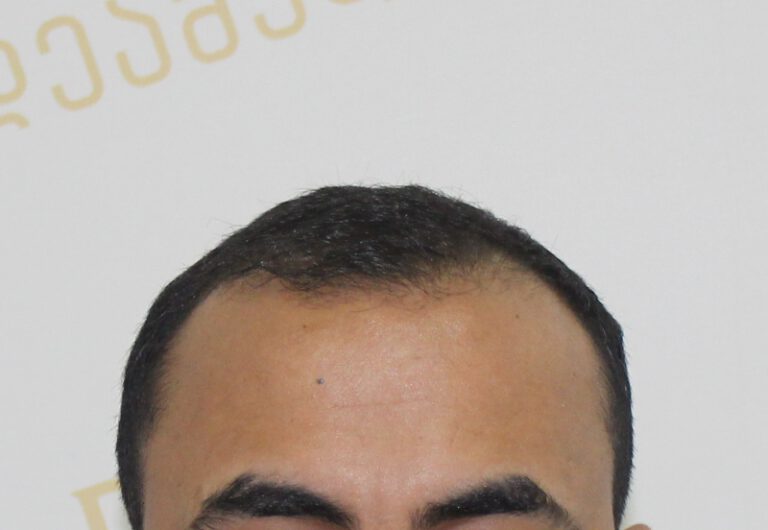 Deamed - hair transplantation results / თმის გადანერგვის შედეგები