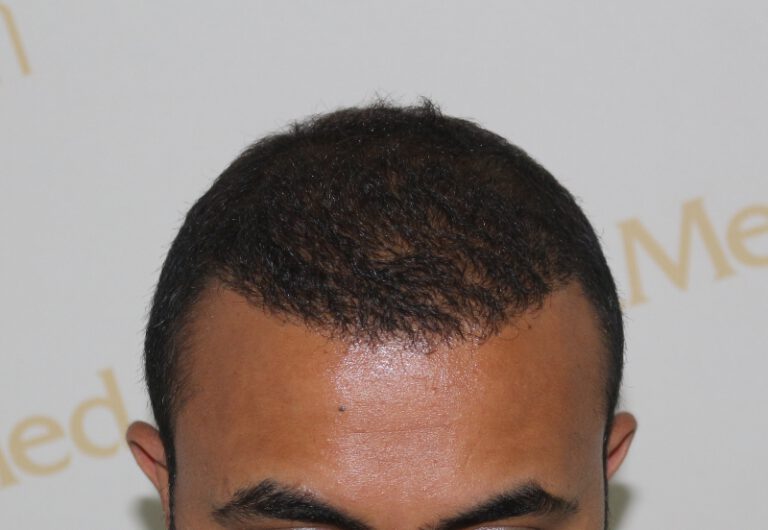 Deamed - hair transplantation results / თმის გადანერგვის შედეგები