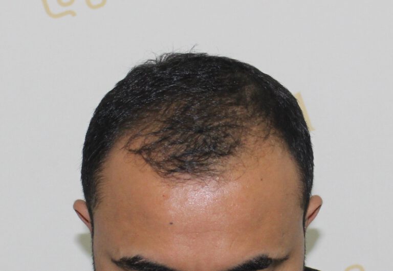 Deamed - hair transplantation results / თმის გადანერგვის შედეგები