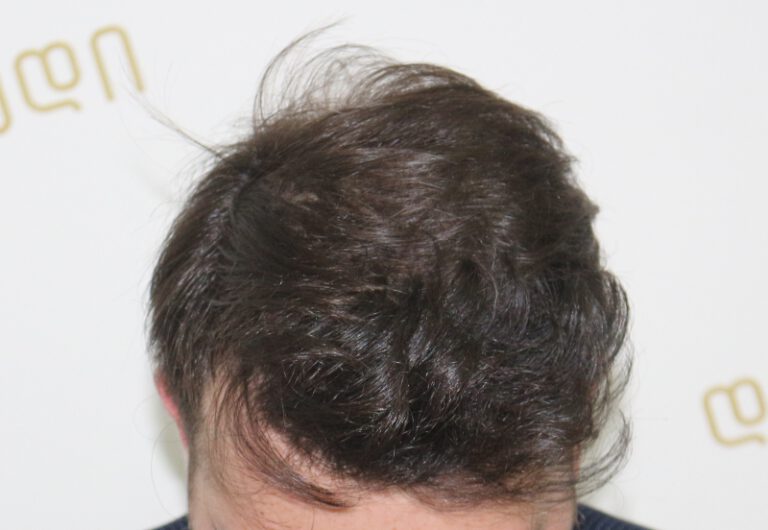 Deamed - hair transplantation results / თმის გადანერგვის შედეგები