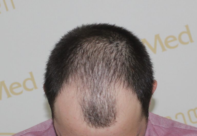 Deamed - hair transplantation results / თმის გადანერგვის შედეგები