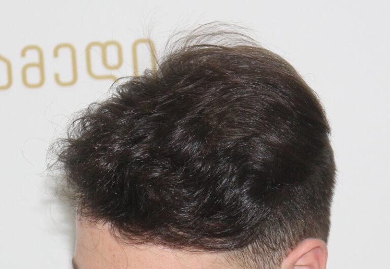 Deamed - hair transplantation results / თმის გადანერგვის შედეგები