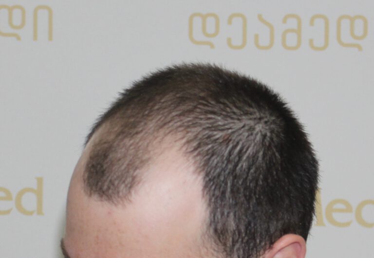 Deamed - hair transplantation results / თმის გადანერგვის შედეგები