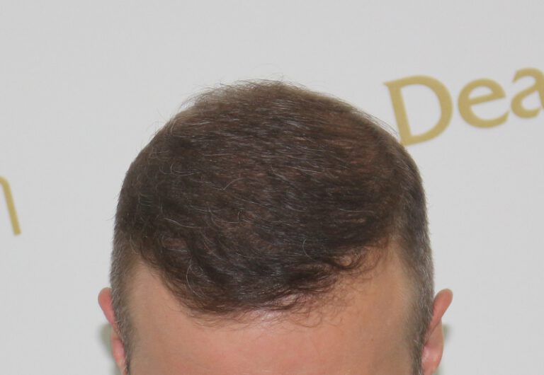 Deamed - hair transplantation results / თმის გადანერგვის შედეგები