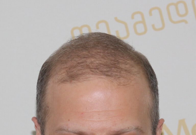 Deamed - hair transplantation results / თმის გადანერგვის შედეგები