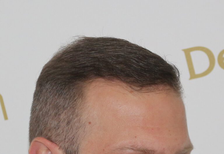 Deamed - hair transplantation results / თმის გადანერგვის შედეგები
