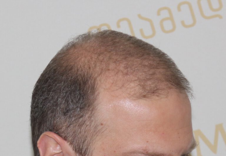 Deamed - hair transplantation results / თმის გადანერგვის შედეგები