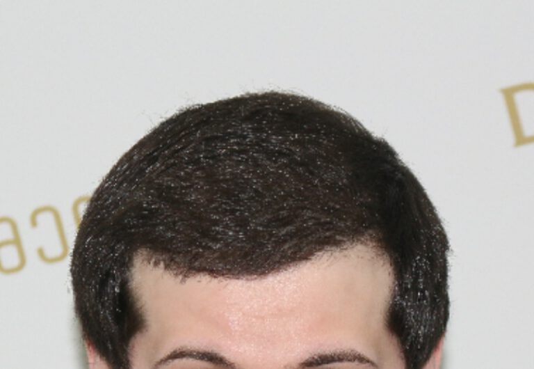 Deamed - hair transplantation results / თმის გადანერგვის შედეგები