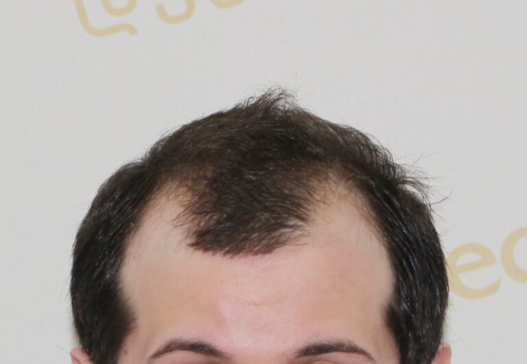 Deamed - hair transplantation results / თმის გადანერგვის შედეგები