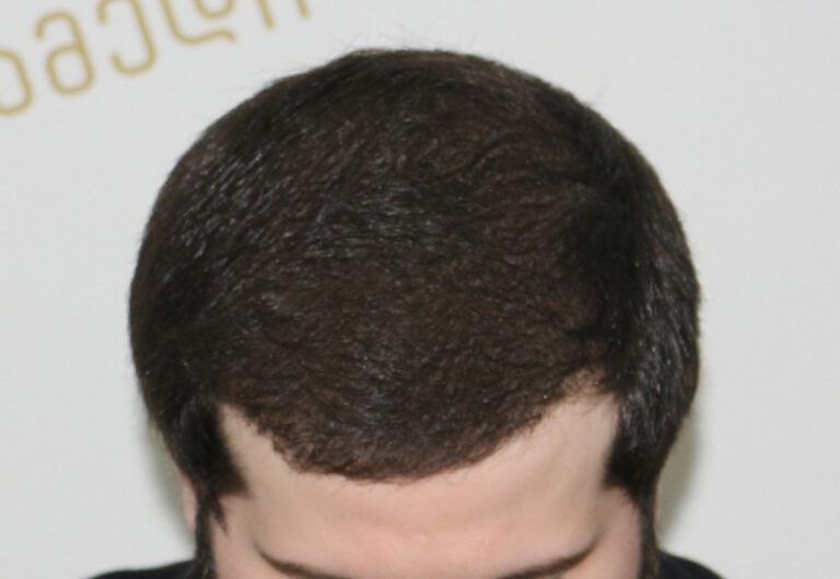 Deamed - hair transplantation results / თმის გადანერგვის შედეგები