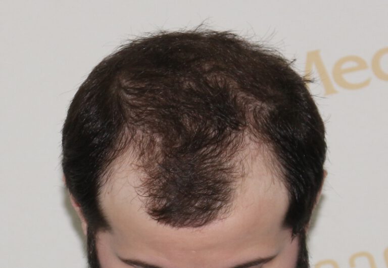 Deamed - hair transplantation results / თმის გადანერგვის შედეგები