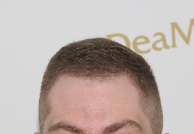 Deamed - hair transplantation results / თმის გადანერგვის შედეგები