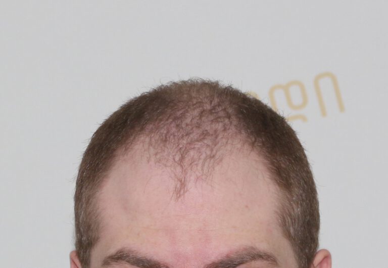 Deamed - hair transplantation results / თმის გადანერგვის შედეგები