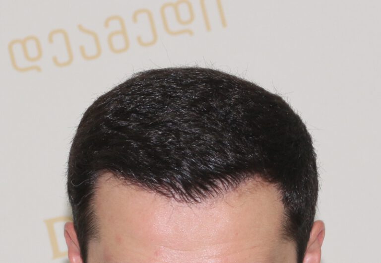 Deamed - hair transplantation results / თმის გადანერგვის შედეგები