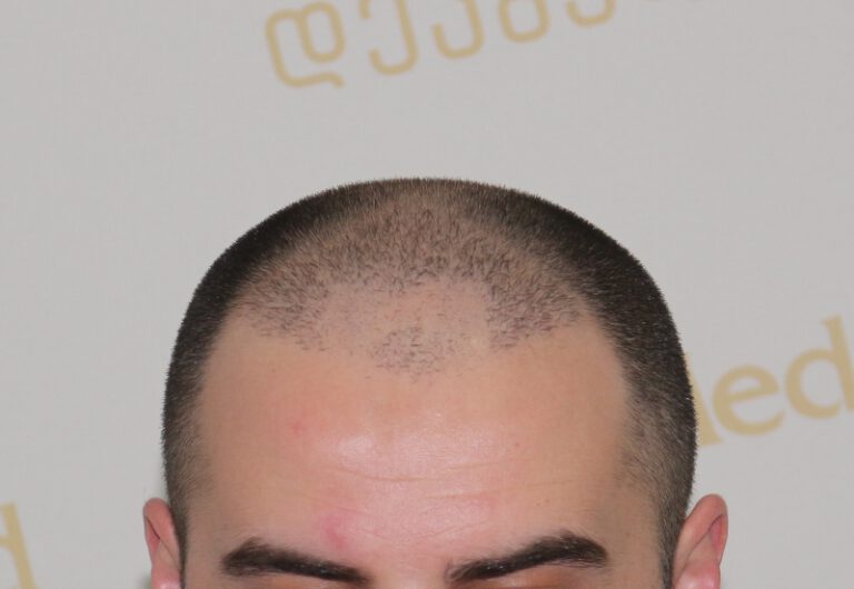 Deamed - hair transplantation results / თმის გადანერგვის შედეგები