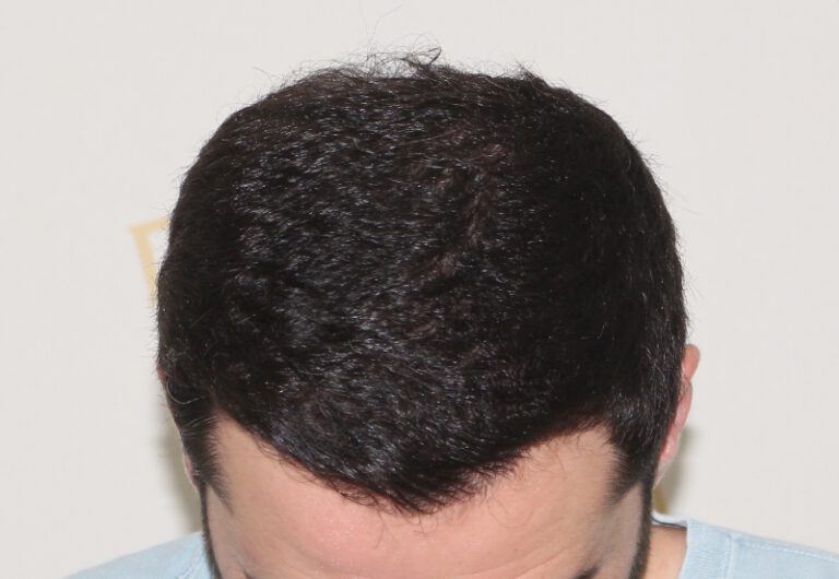 Deamed - hair transplantation results / თმის გადანერგვის შედეგები