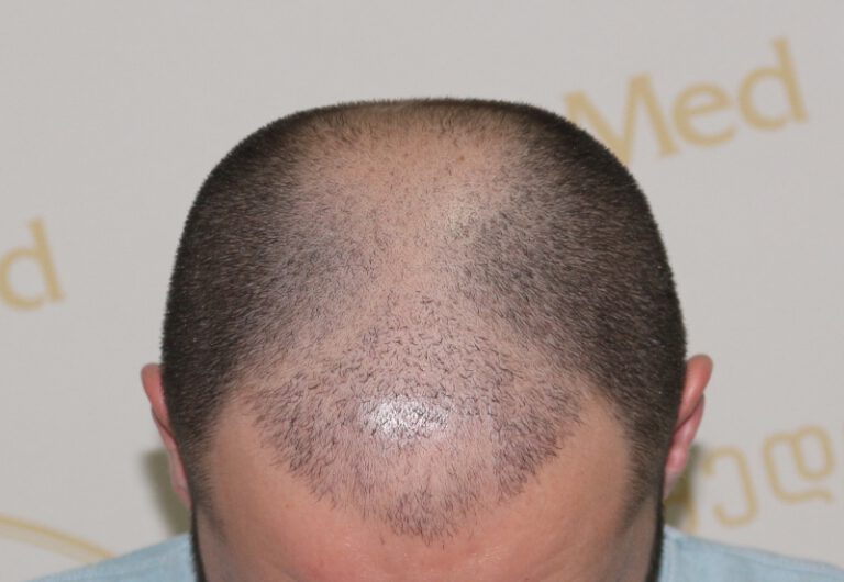 Deamed - hair transplantation results / თმის გადანერგვის შედეგები