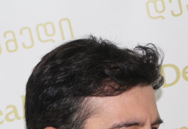 Deamed - hair transplantation results / თმის გადანერგვის შედეგები