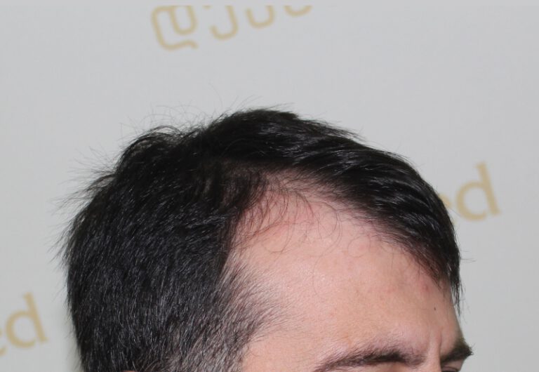 Deamed - hair transplantation results / თმის გადანერგვის შედეგები