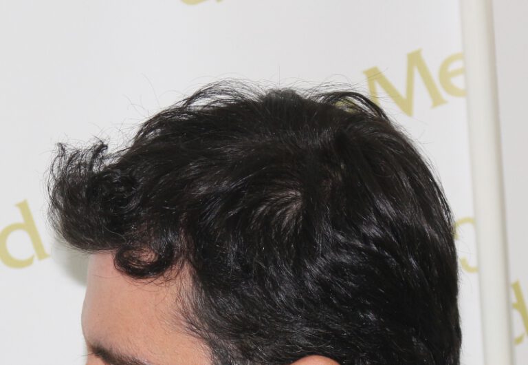 Deamed - hair transplantation results / თმის გადანერგვის შედეგები