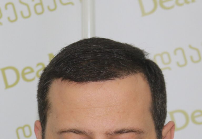 Deamed - hair transplantation results / თმის გადანერგვის შედეგები