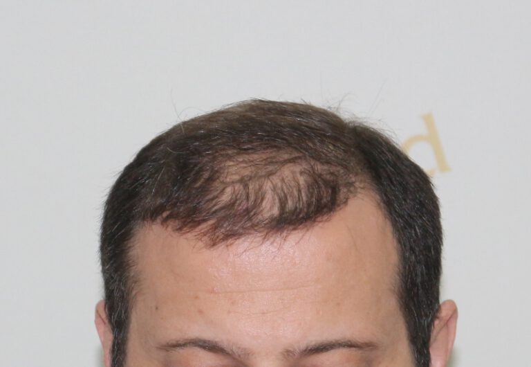 Deamed - hair transplantation results / თმის გადანერგვის შედეგები