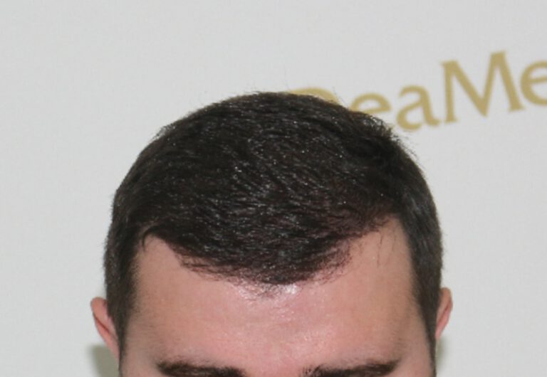 Deamed - hair transplantation results / თმის გადანერგვის შედეგები